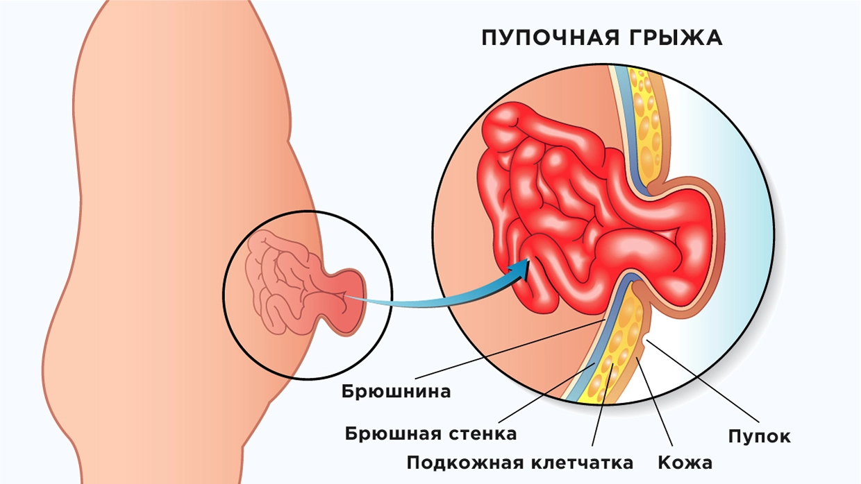 Удаление грыжи брюшной стенки бесплатно по ОМС